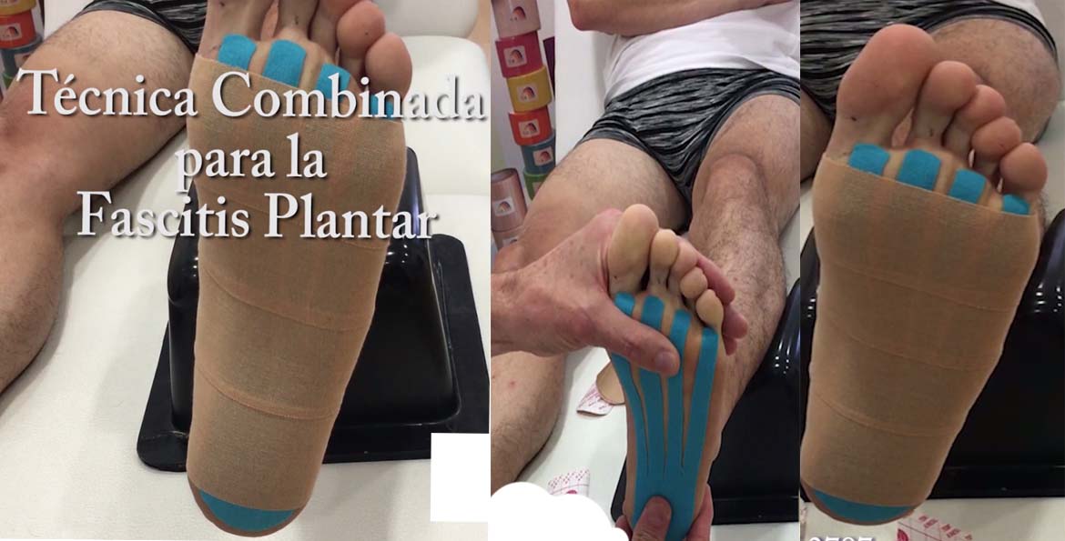 Técnica Combinada de Kinesiotaping para la Fascitis Plantar. Biolaster